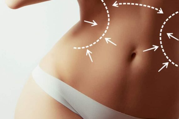 Achieve Your Dream Body With Vaser Liposuction