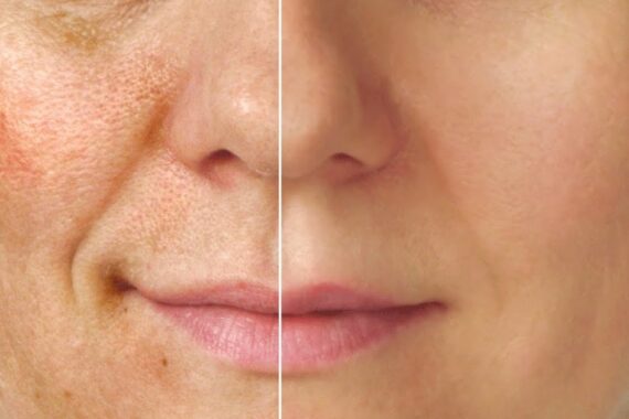 Can Pigmentation Be Cured Permanently