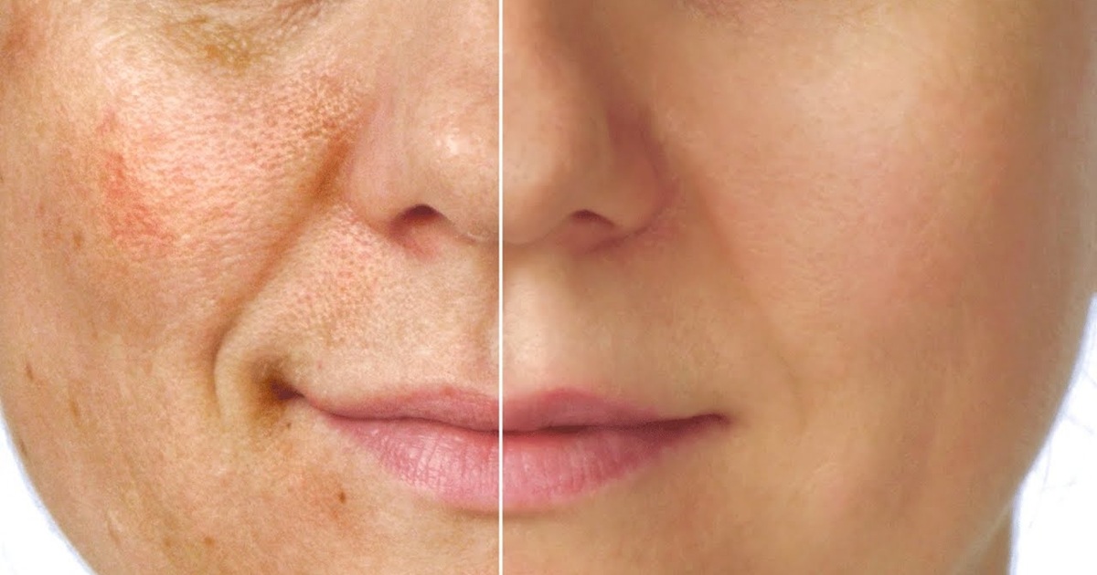 Can Pigmentation Be Cured Permanently