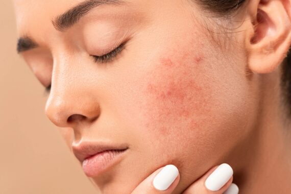 Can Skin Whitening Cause Allergies