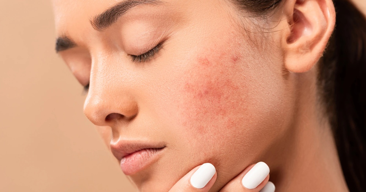 Can Skin Whitening Cause Allergies