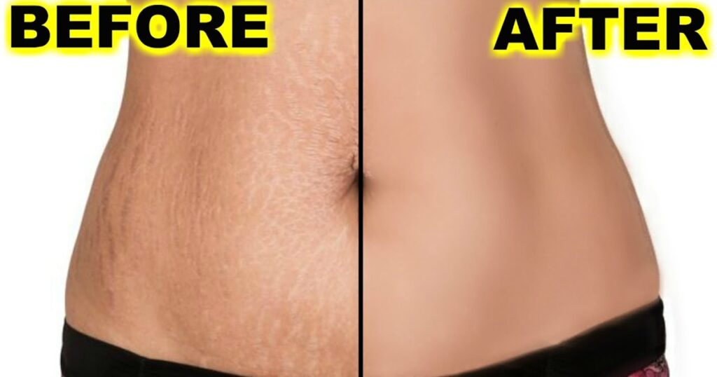 Can laser Remove Stretch Marks Permanently