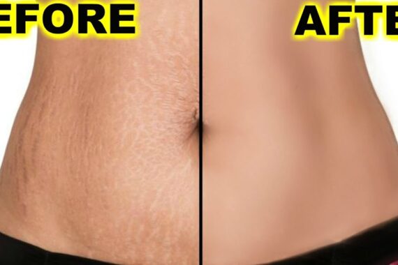 Can laser Remove Stretch Marks Permanently