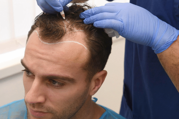 Discover the Art of Hair Restoration with Dr Afsheen