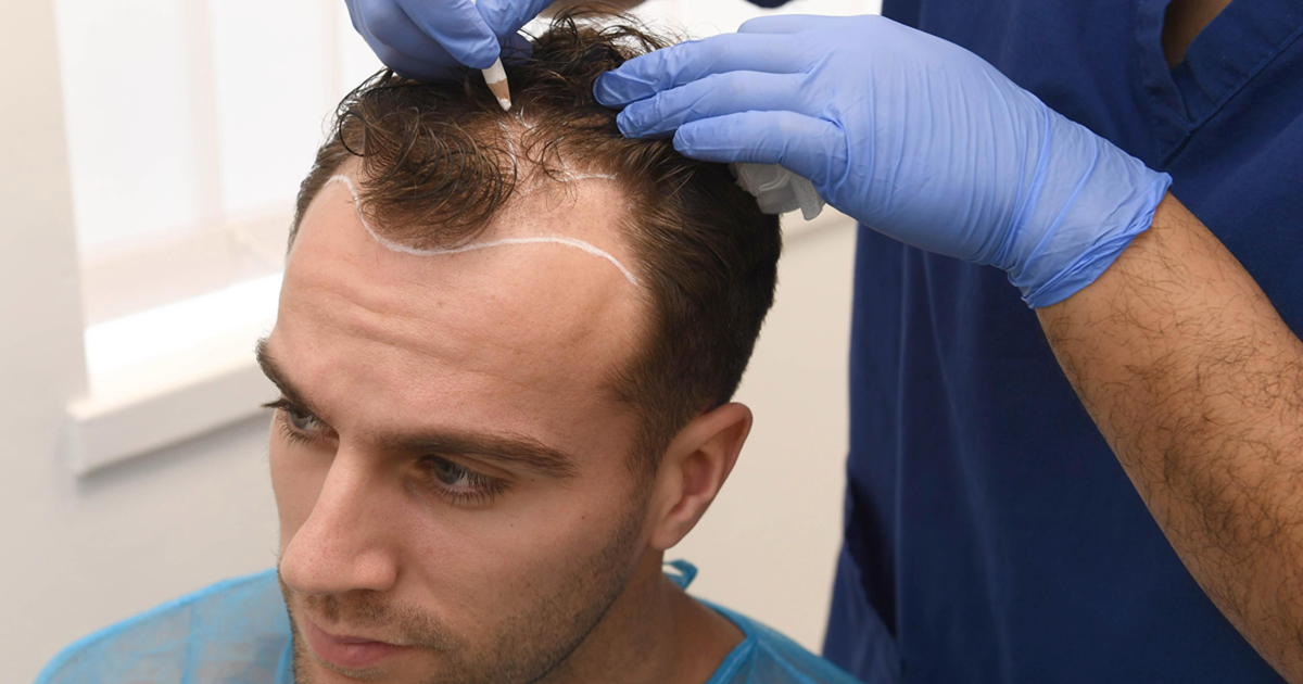 Discover the Art of Hair Restoration with Dr Afsheen