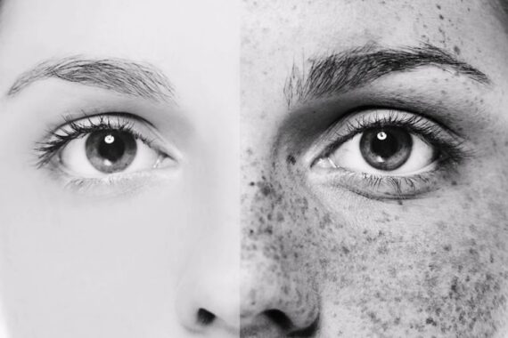 Does Pigmentation Come Back After Laser