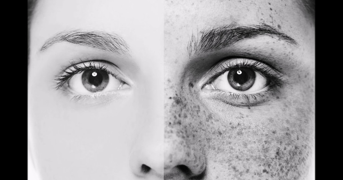 Does Pigmentation Come Back After Laser