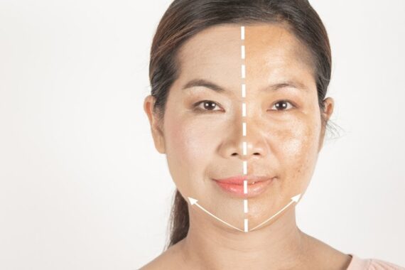 Does microneedling help with melasma?