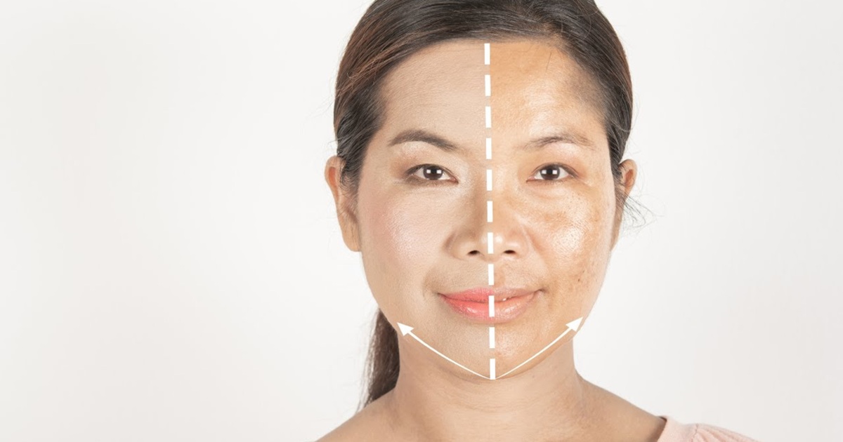 Does microneedling help with melasma?