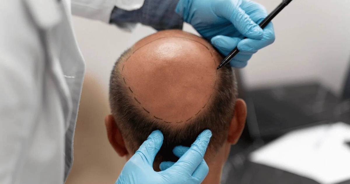 FUE Transplant Breakthrough in Islamabad