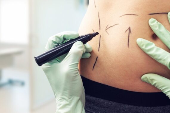 How Liposuction Can Boost Your Confidence