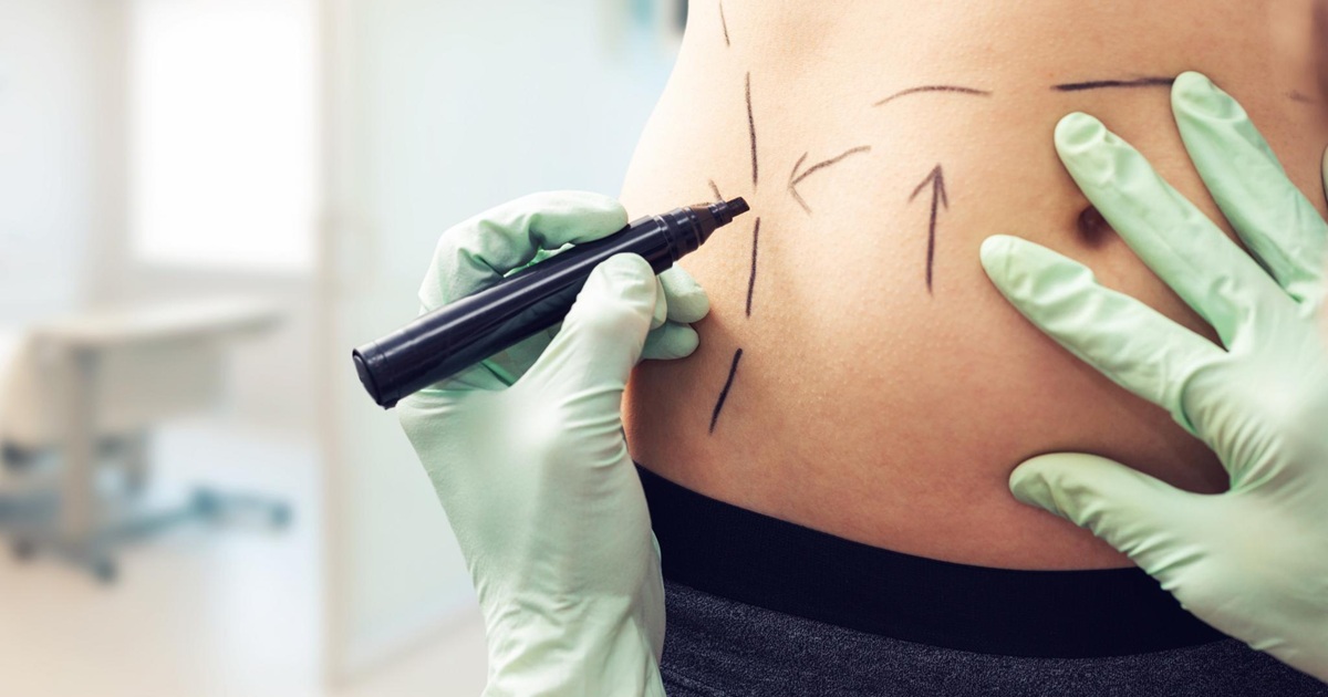 How Liposuction Can Boost Your Confidence