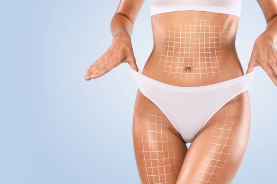 How Long Does It Take to Recover From Liposuction