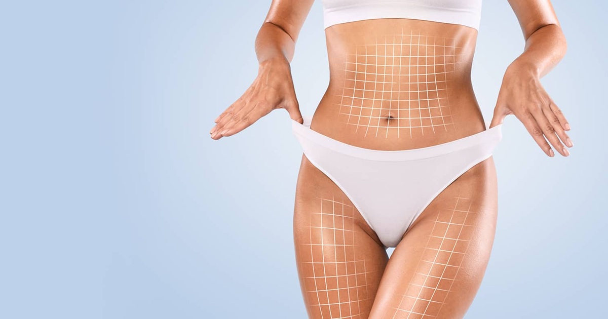 How Long Does It Take to Recover From Liposuction