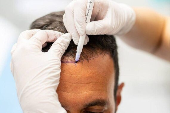 How to Prepare for Hair Transplant Surgery