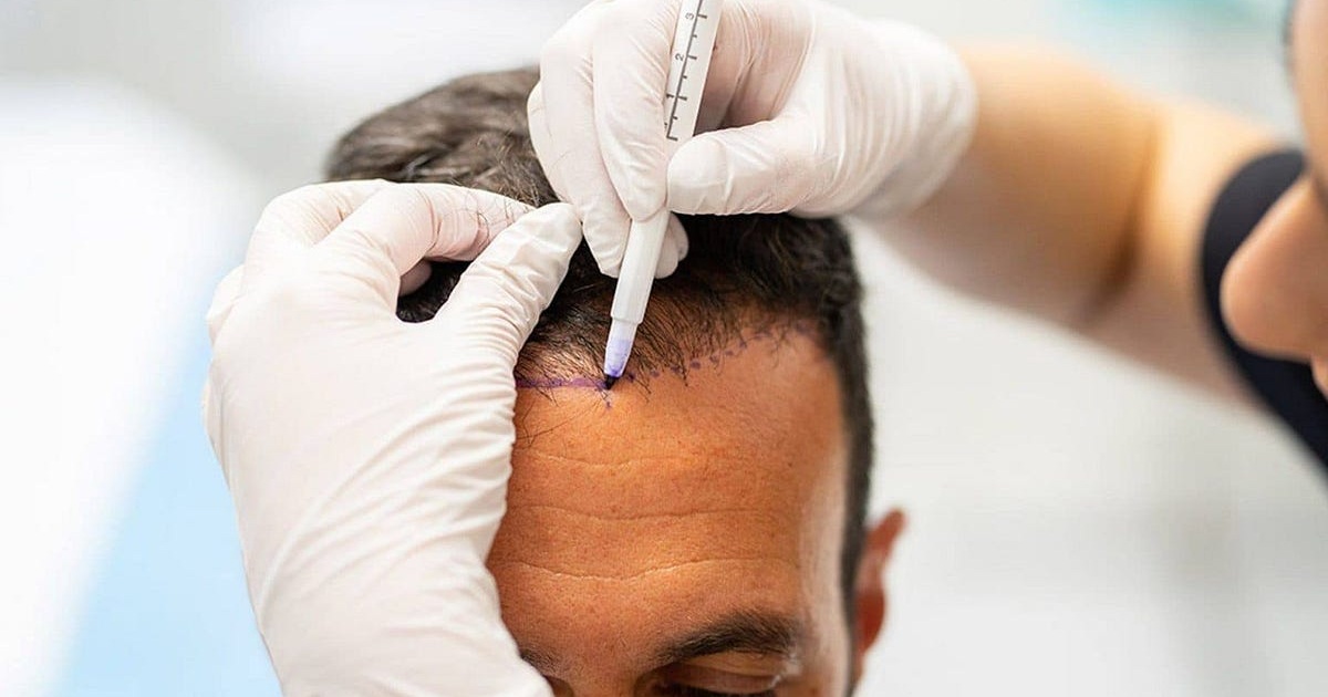 How to Prepare for Hair Transplant Surgery