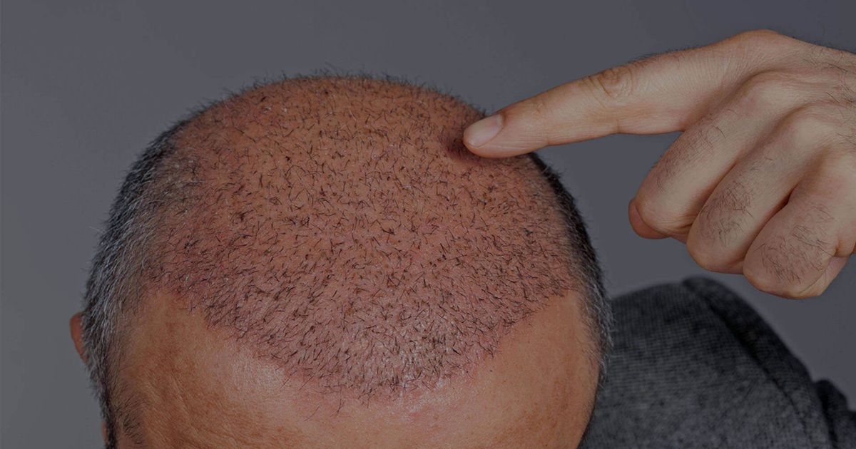 What to Expect After Getting Hair Implants