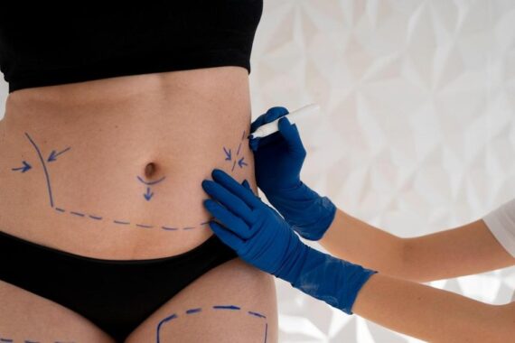 Why Is Liposuction The Best Fat Removal Method