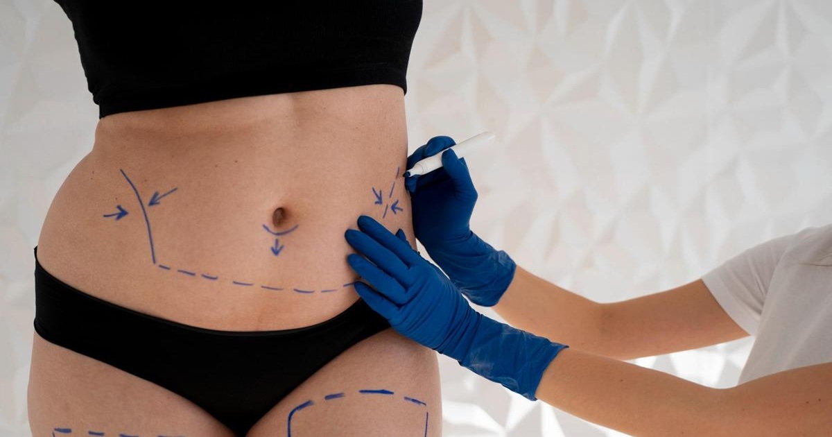 Why Is Liposuction The Best Fat Removal Method