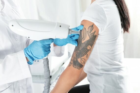 Can a Tattoo Be Fully Removed