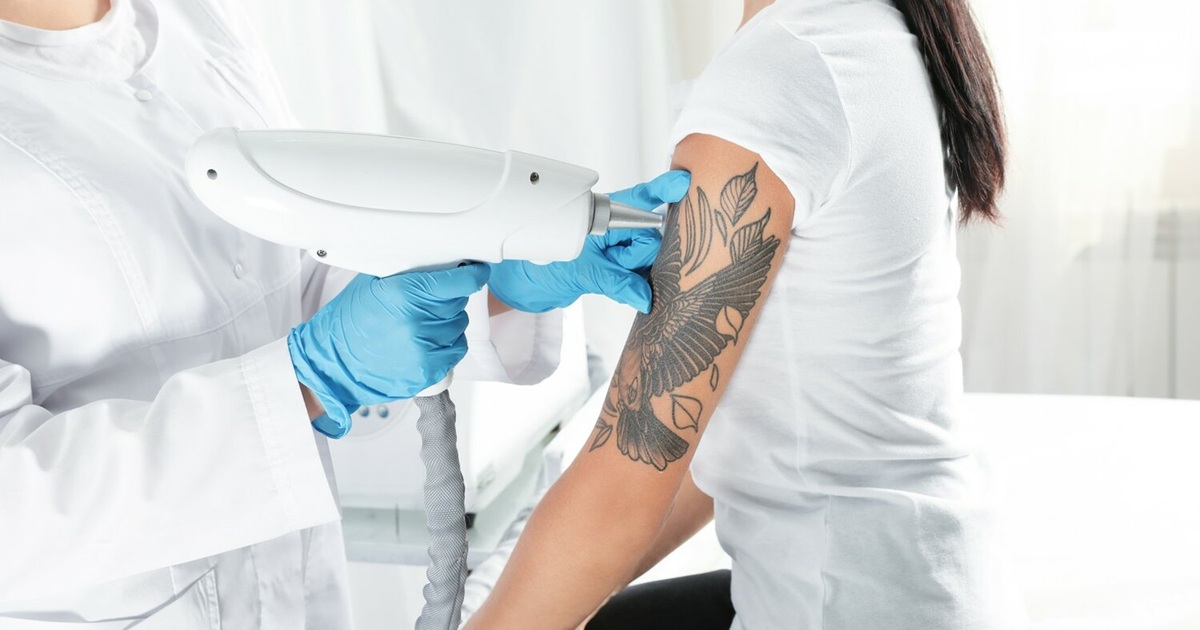 Can a Tattoo Be Fully Removed