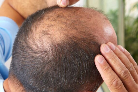 Hair Growth Timeline After Hair Transplant