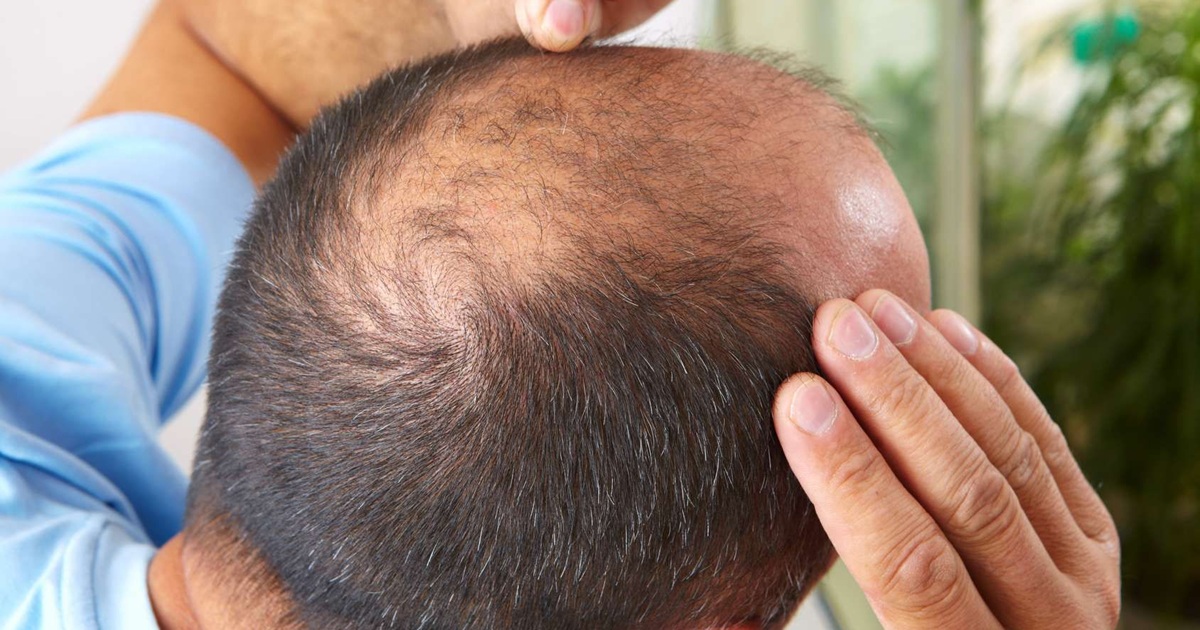 Hair Growth Timeline After Hair Transplant