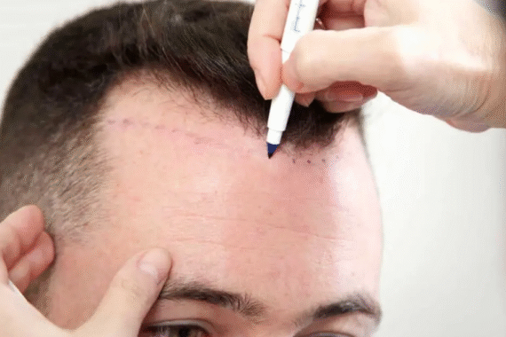 Is Hair Transplant 100% Successful?
