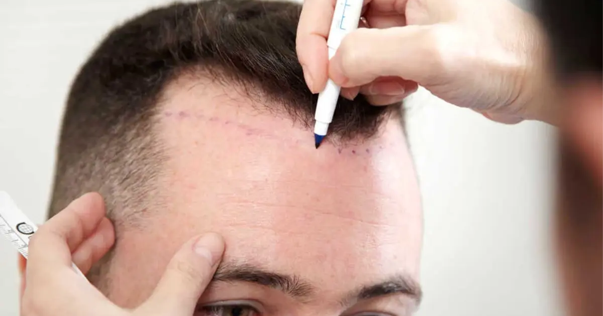 Is Hair Transplant 100% Successful?