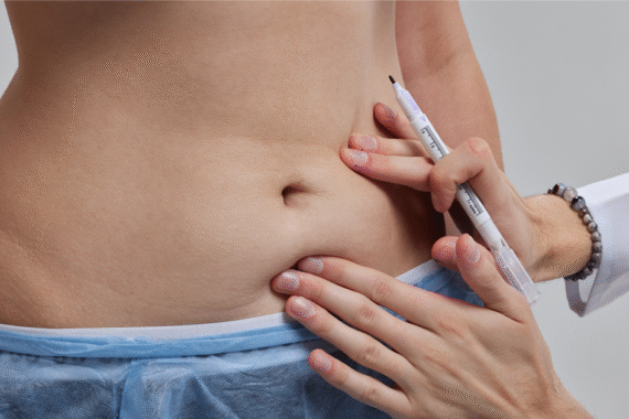 Is Liposuction Haram in Islam?