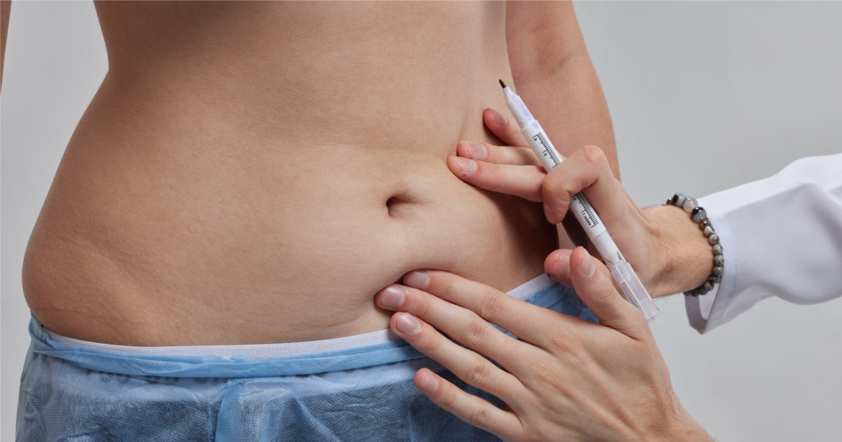 Is Liposuction Haram in Islam?