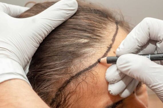 Can Females Get Hair Transplantation?