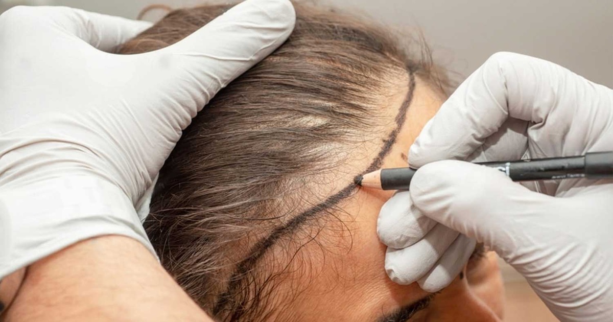 Can Females Get Hair Transplantation?