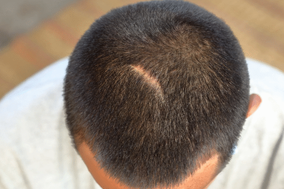 Do Hair Transplants Leave Scars?