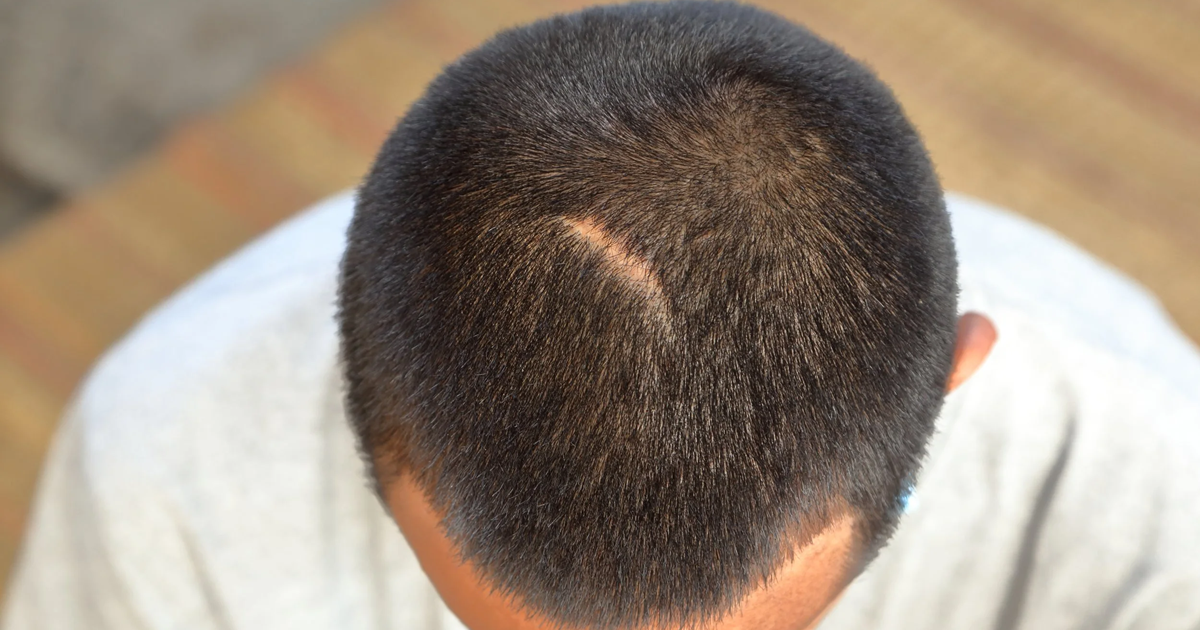 Do Hair Transplants Leave Scars?