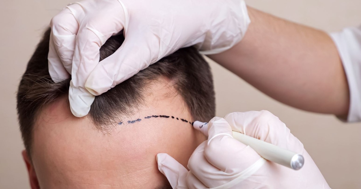 How to Get Satisfied with the Results of a Hair Transplant