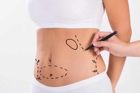 Is Liposuction a Safe Procedure