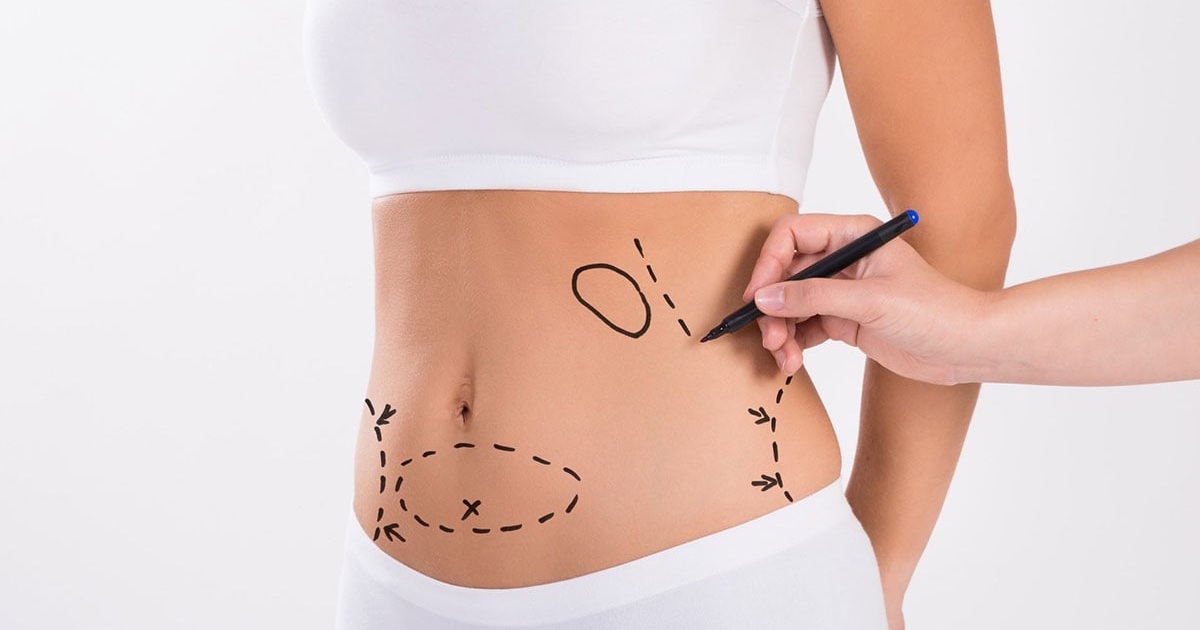 Is Liposuction a Safe Procedure