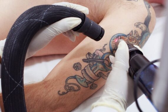 Tattoo Removal by Q Switch Laser What to Expect