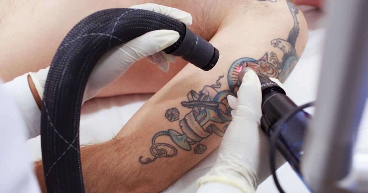 Tattoo Removal by Q-Switch Laser: What to Expect
