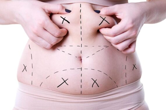 Would My Skin Get Loose After Liposuction Surgery