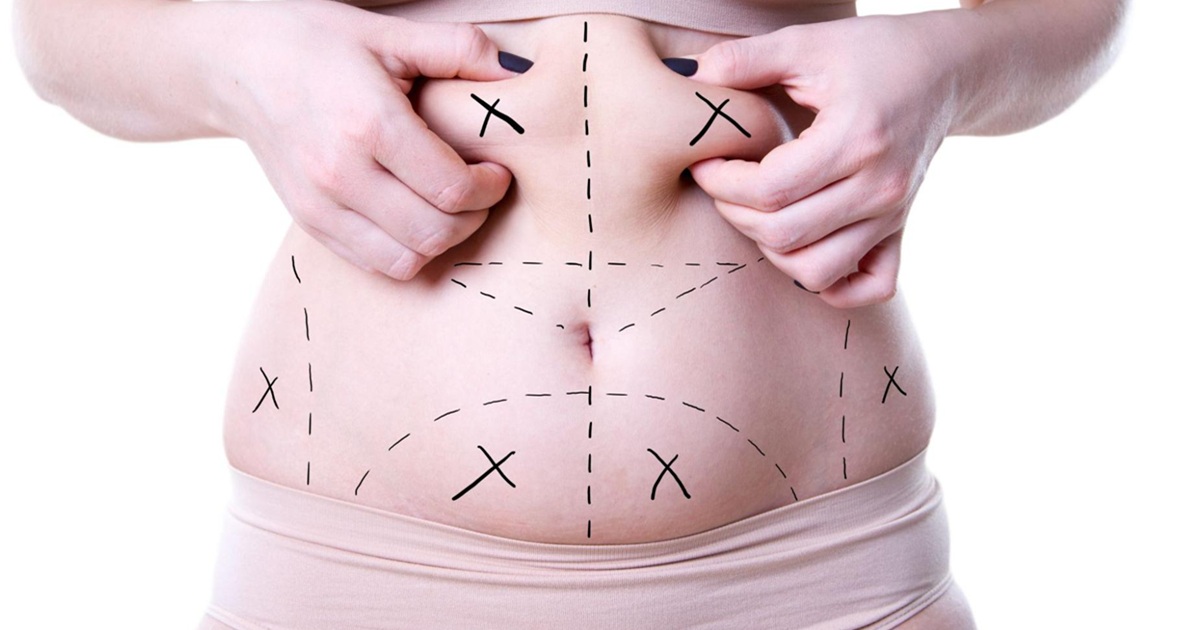 Would My Skin Get Loose After Liposuction Surgery