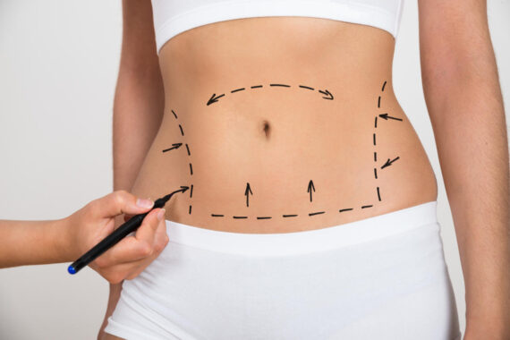 Affordable Tummy Tuck Surgery