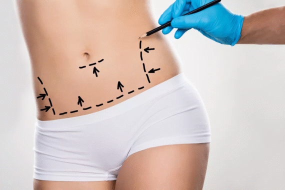 Important Facts about Tummy Tuck Treatment