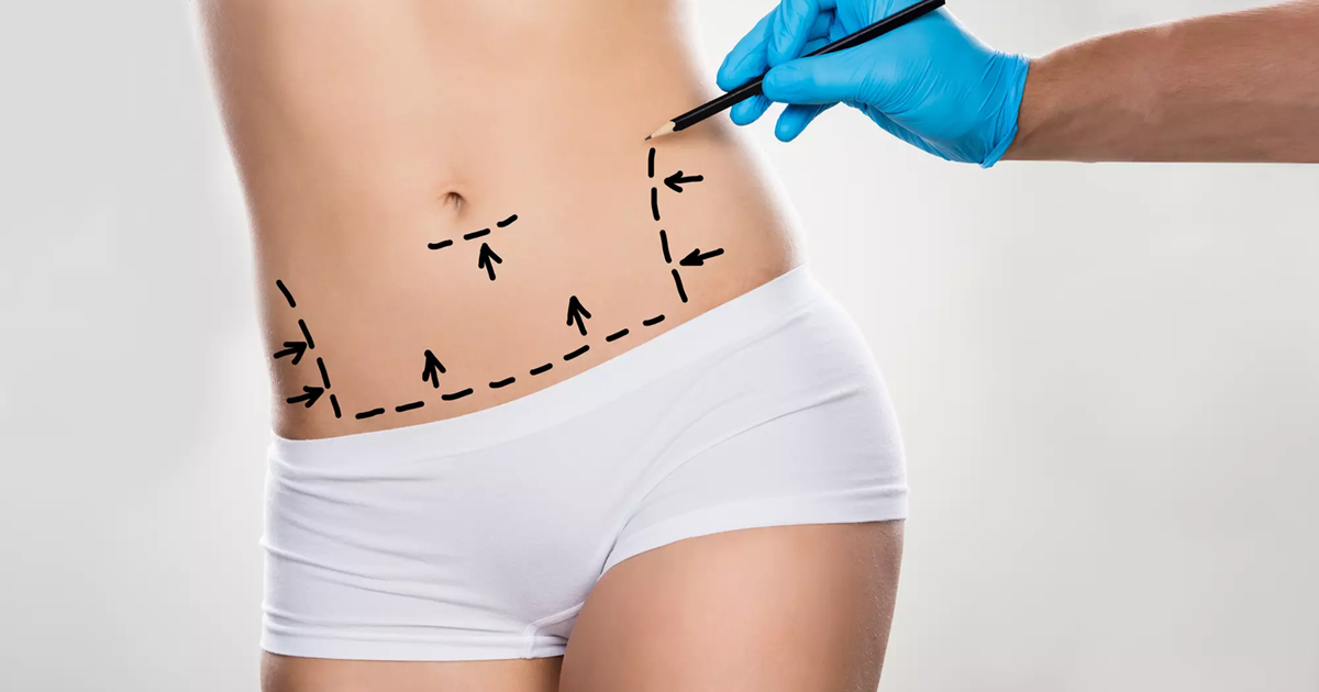 Important Facts about Tummy Tuck Treatment