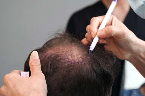 Hair Transplant + Exosomes A Growth Boost