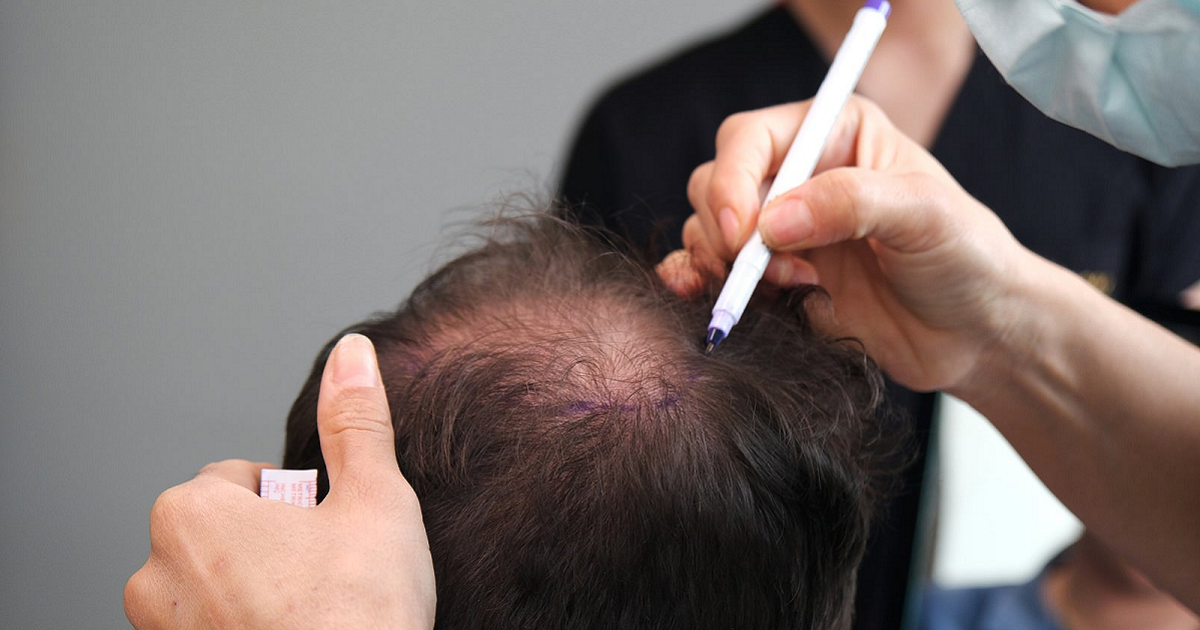 Hair Transplant + Exosomes A Growth Boost