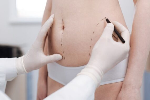 Minimally Invasive Liposuction in 2025