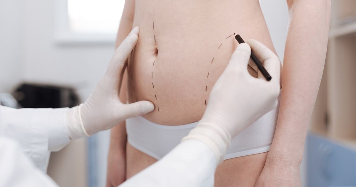 Minimally Invasive Liposuction in 2025