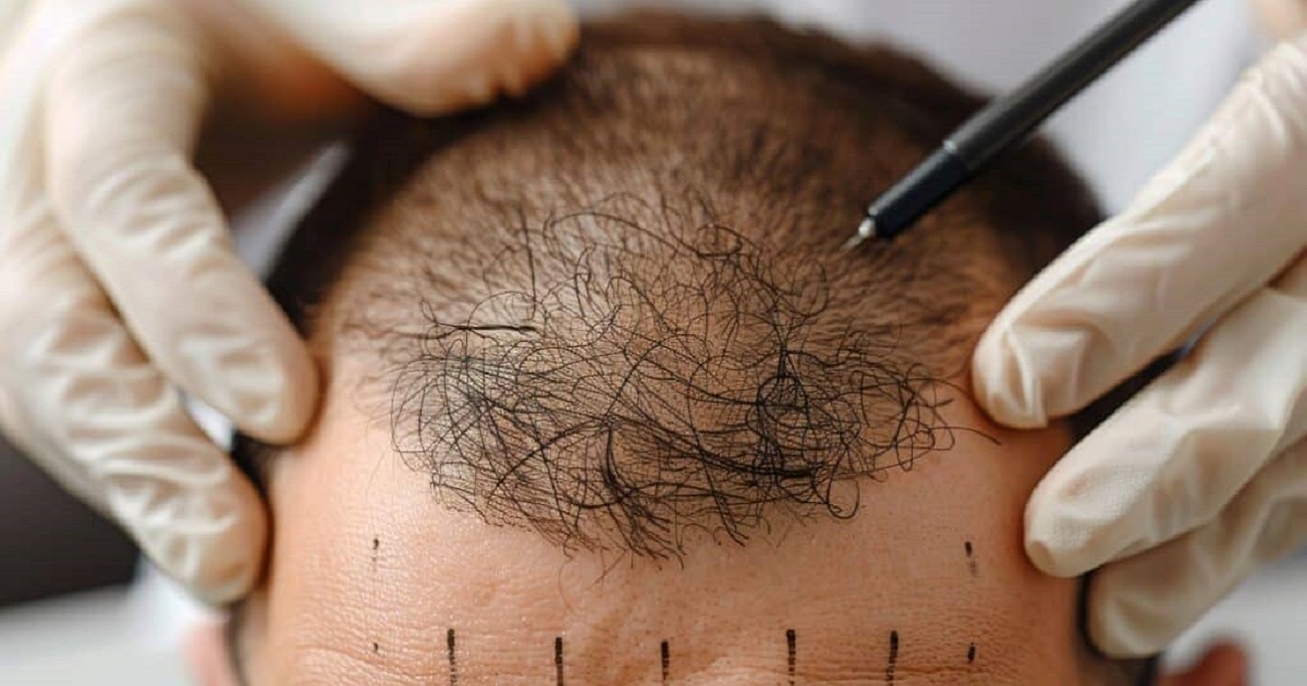 Natural-Looking Hair Transplants Explained